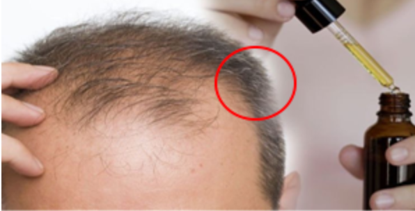 New Hair Regrowth With Stem Cells